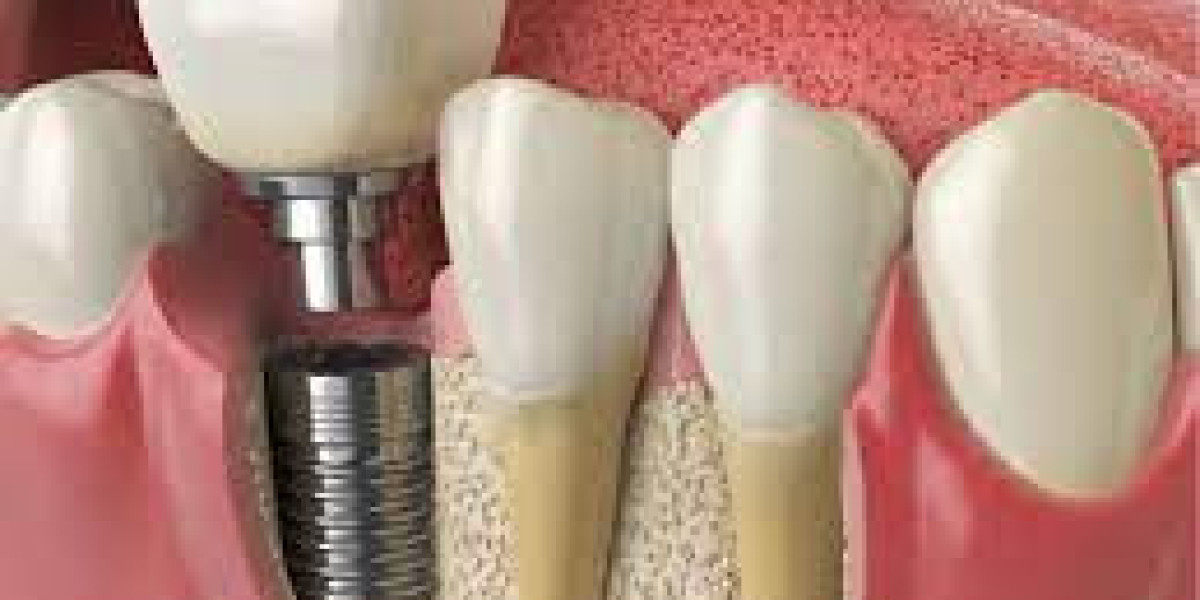 Budget-Friendly Single Tooth Implant Solutions in Dubai