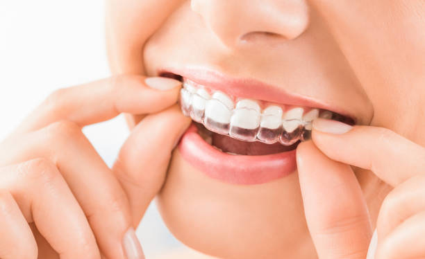 Invisalign - The Treatment Process | TheAmberPost