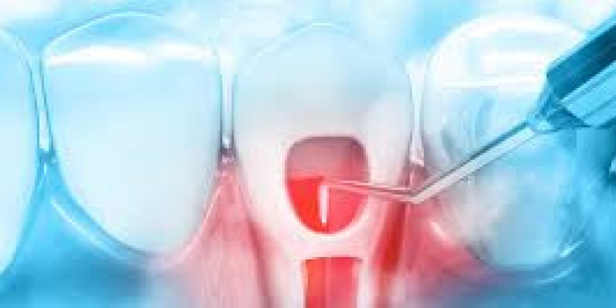 Root Canal Therapy: Addressing Common Patient Questions