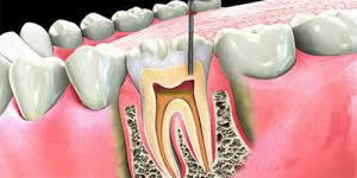 How to Prepare for Your Root Canal Appointment