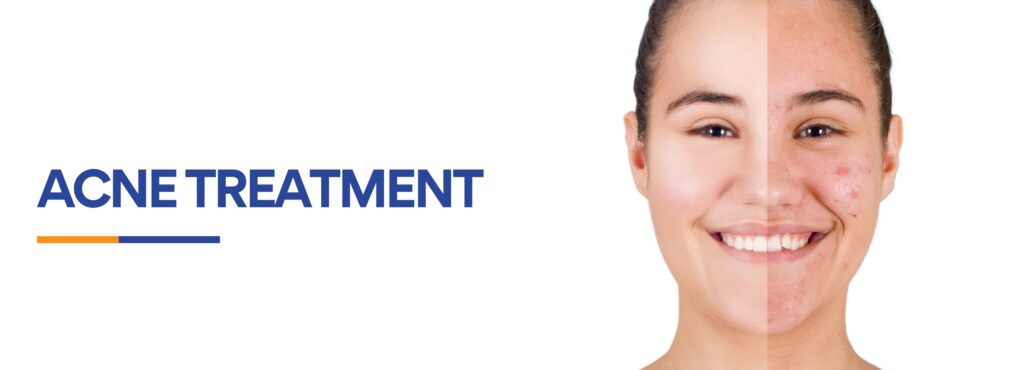 Acne Treatment in Roorkee - ACE Clinic