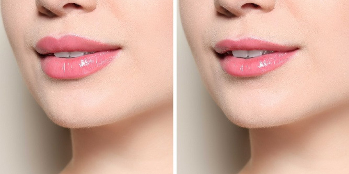 The Psychological Impact of Lip Reduction Surgery in Islamabad