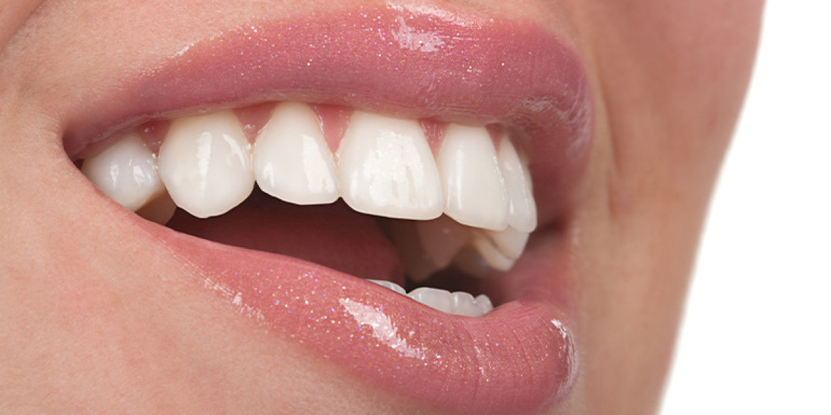 Why E-Max Veneers Are a Game-Changer in Riyadh